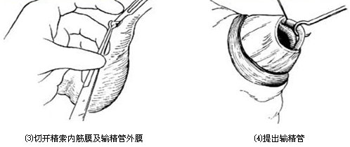男性绝育手术